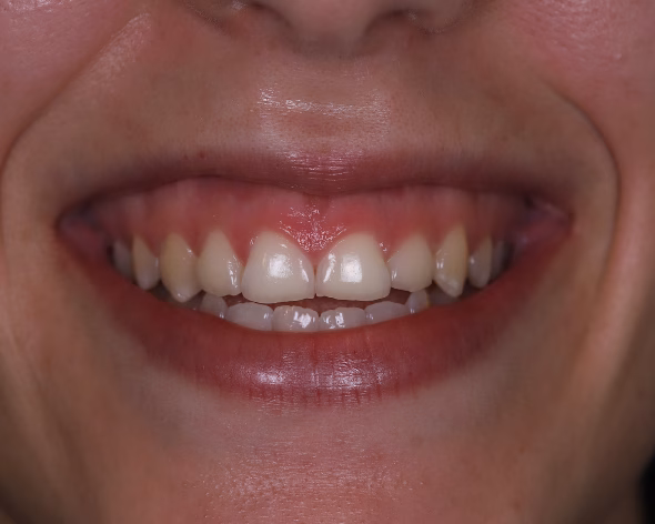 periodontologia<br />
gengivectomia