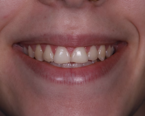 periodontologia<br />
gengivectomia